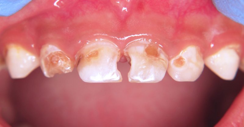 Milk Caries Dental